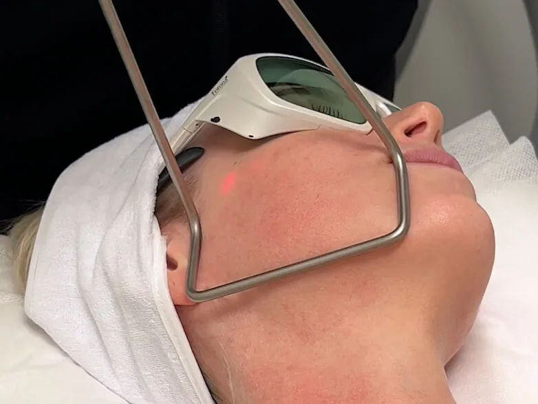 Fotona-laserbehandling med beskyttelsesbriller
